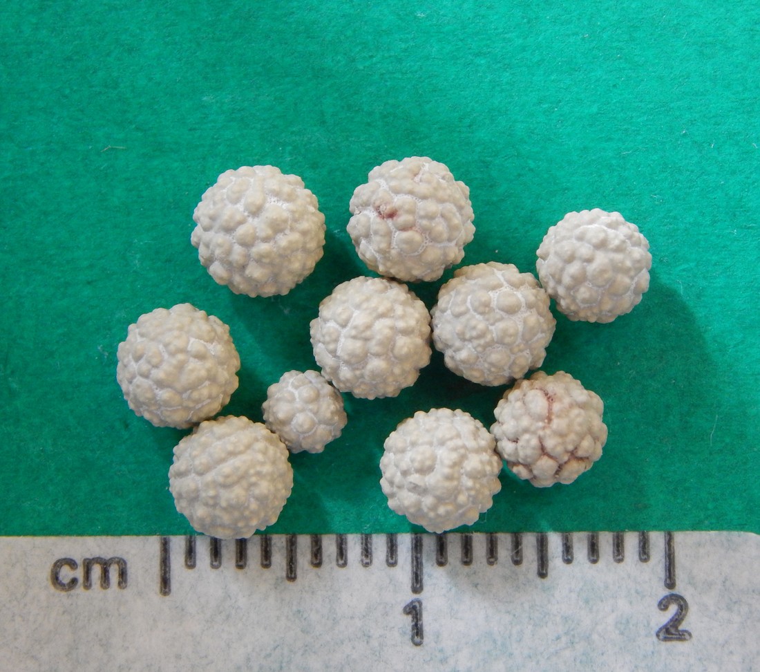 Urinary stones that look like puff balls